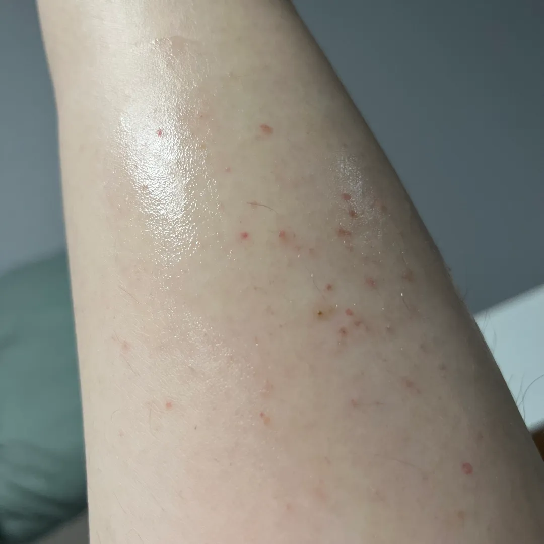 종아리에만 딱 나요 ㅠㅠ