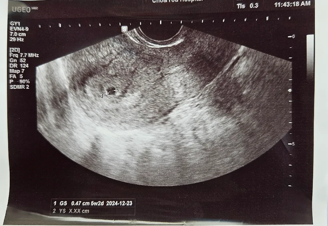 5주2일 아기집보고왔어요!
