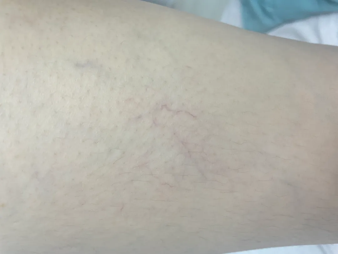 혹시 이거  튼살일까요?ㅠ