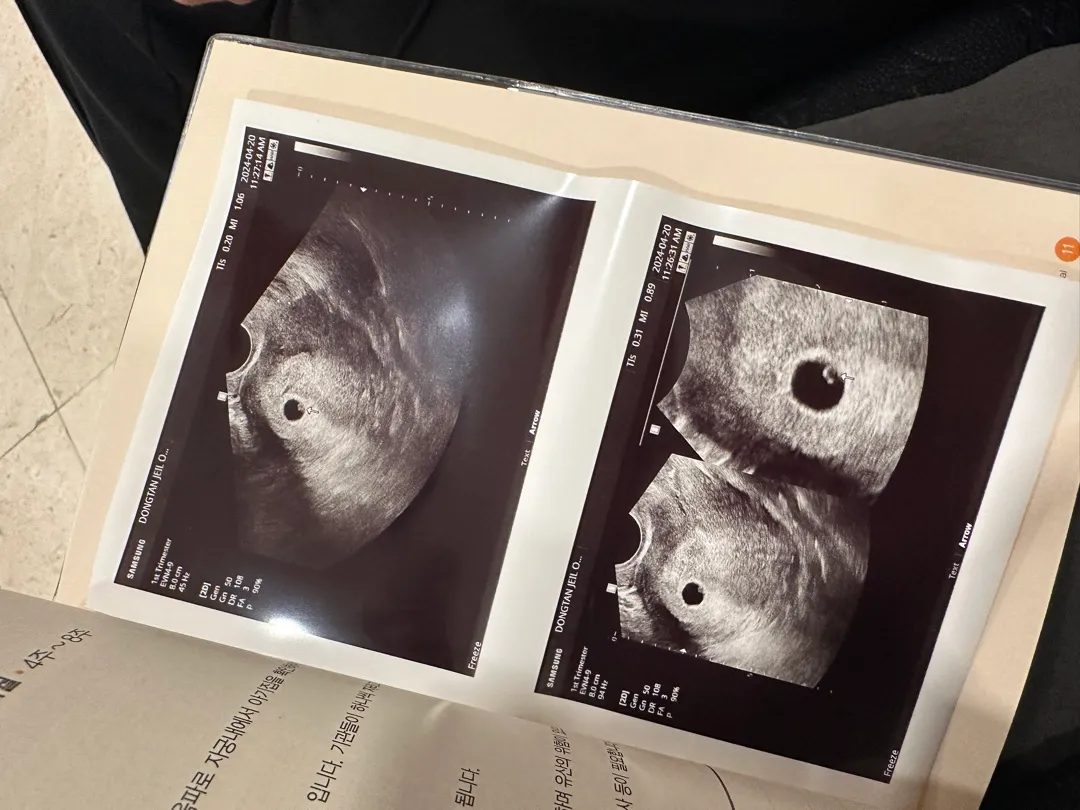5주 아기집 보고 왔어요👶🏻