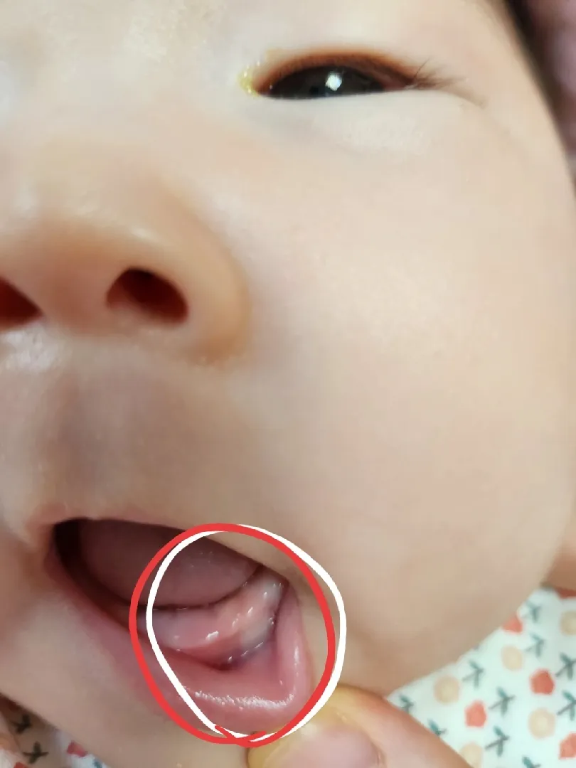 이앓이맞나여?