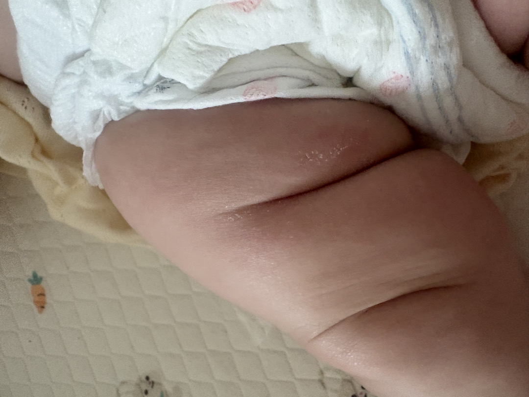 아기 기저귀 쓸림현상