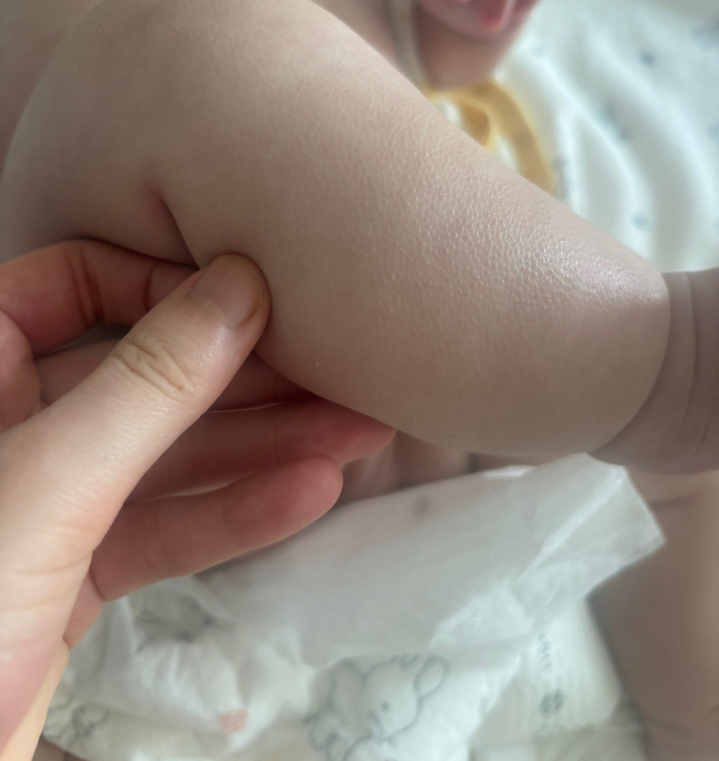 아기 다리 닭살피부