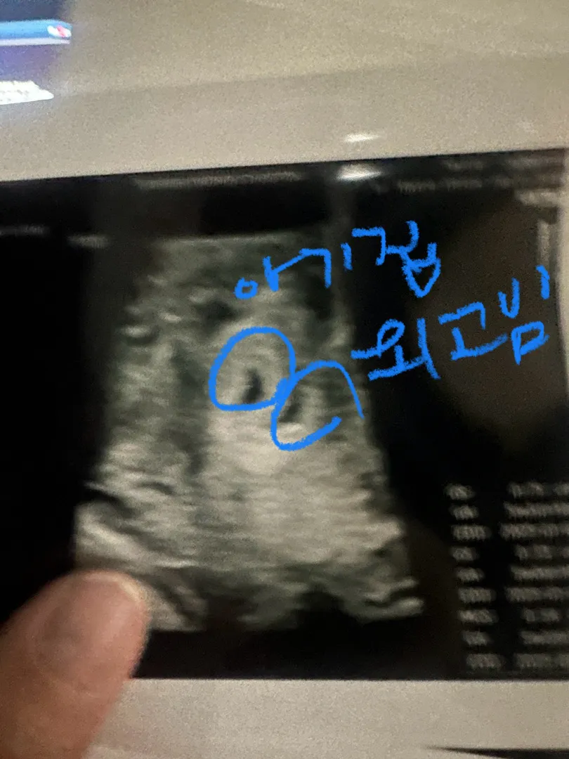 갈색피 출혈이 있었어요😭