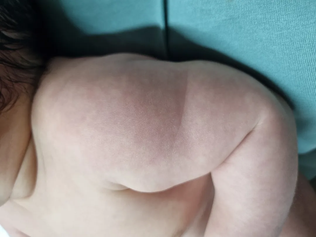 Bcg접종 자국이 안보여요