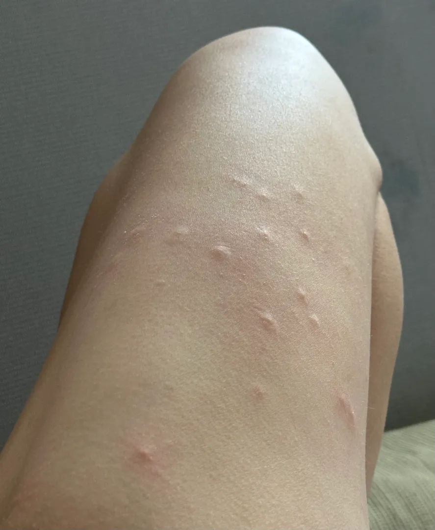 이거 임신성 소양증이려나요?