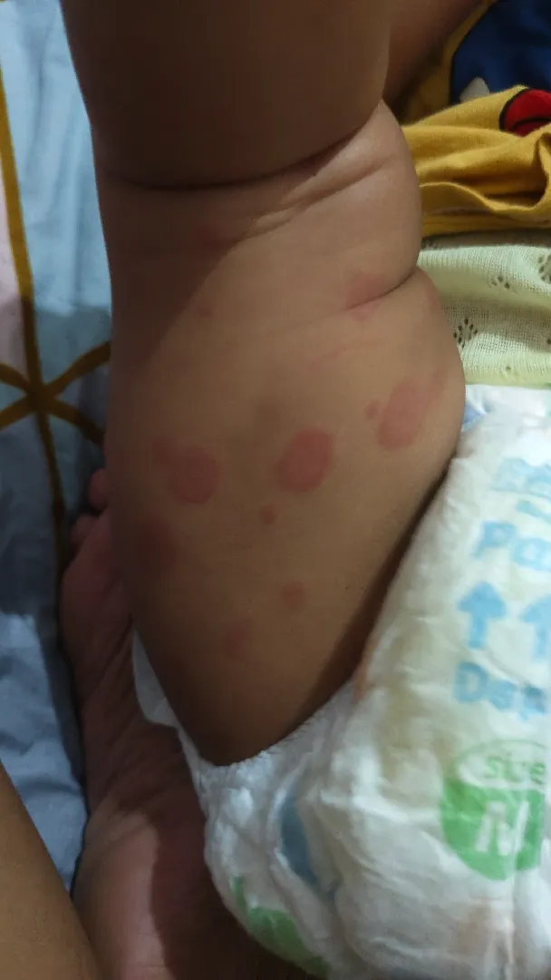 Bentol Merah Pada bayi