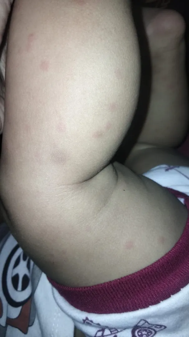 Bintik merah pada bayi 6+ 