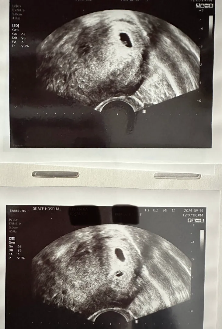 어제 첫 초음파 보고 왔어요! 설마 둥이?
