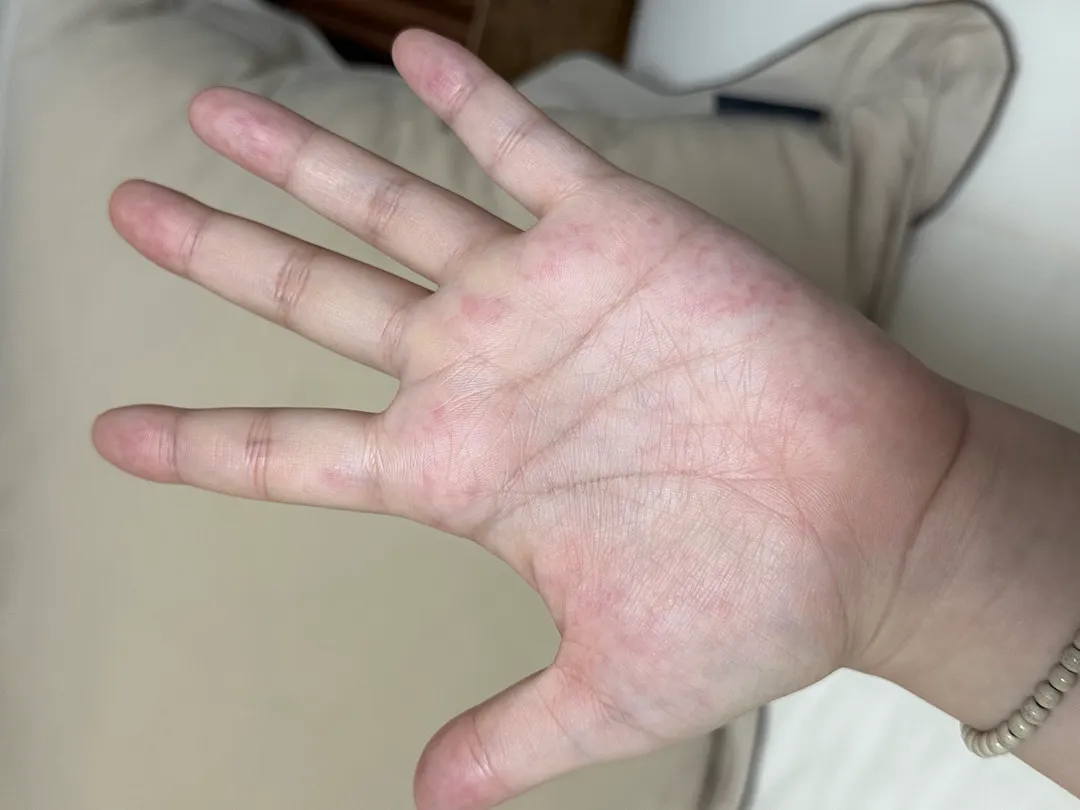 손붓기 저림 병원가면 나을까요ㅠㅠ