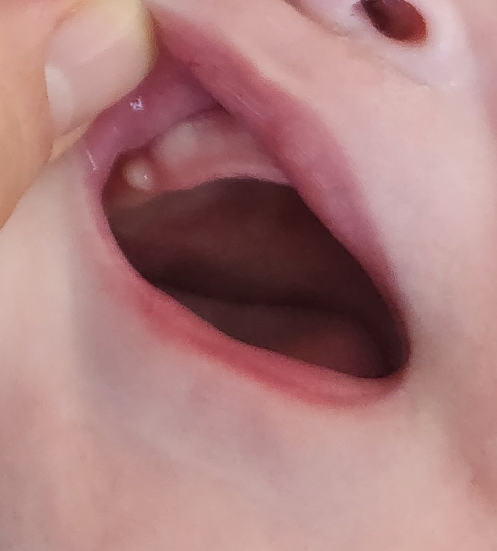 진주종?입안하얀수포같은게뭘까요??