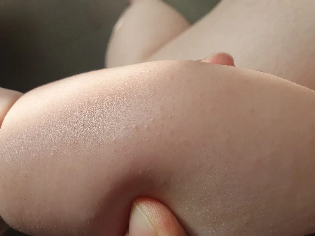 애기 다리피부에 오돌톨하게 생긴 것이 무엇인지 아시는 분 있으실까요?