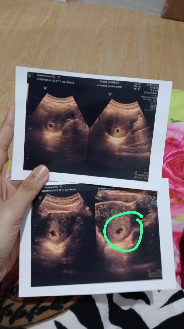 kehilangan buah hati