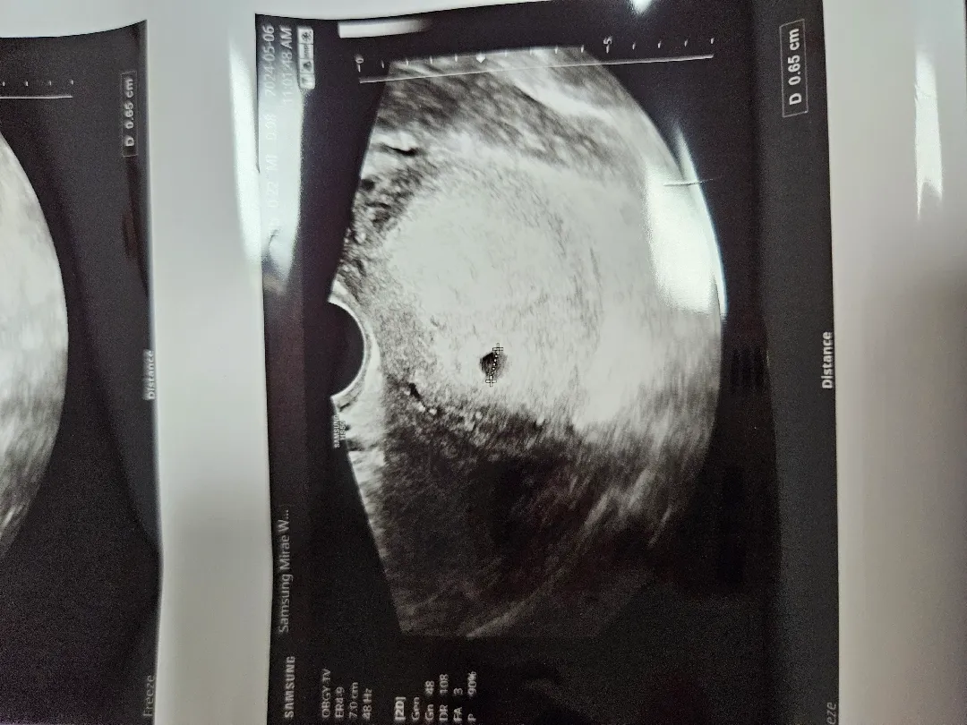 4주6일차 첫초음파 아기집확인><