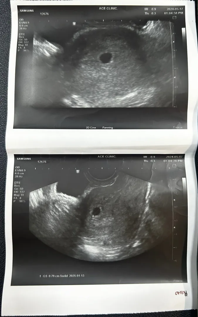 5주차6일 아기집 봐주세요
