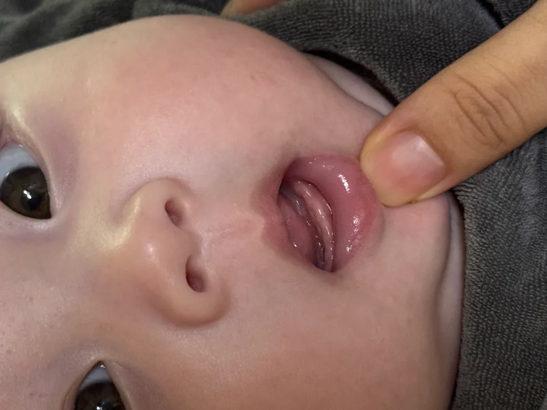 3개월 아기 이가 나려는 구멍일까요...? 