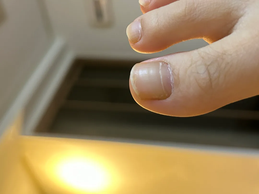 발톱가로줄생겼어요..