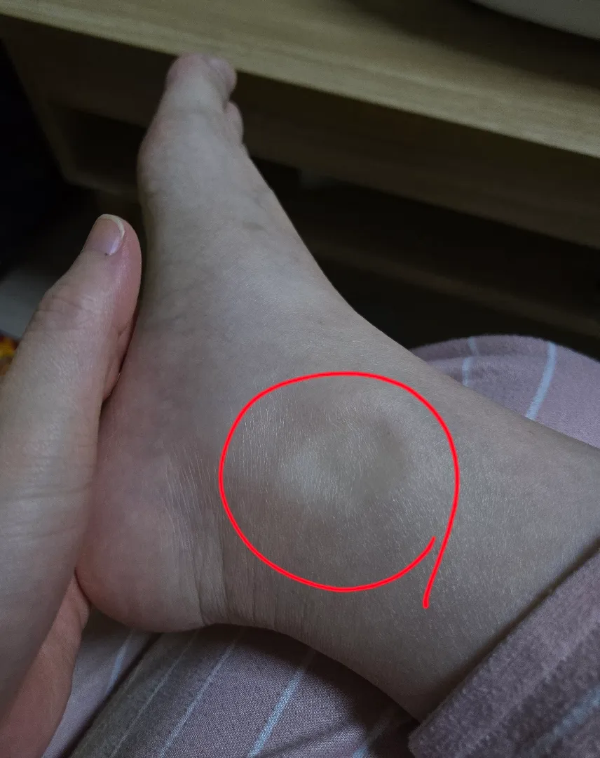 뒷꿈치 아프신분 있나요ㅠ?