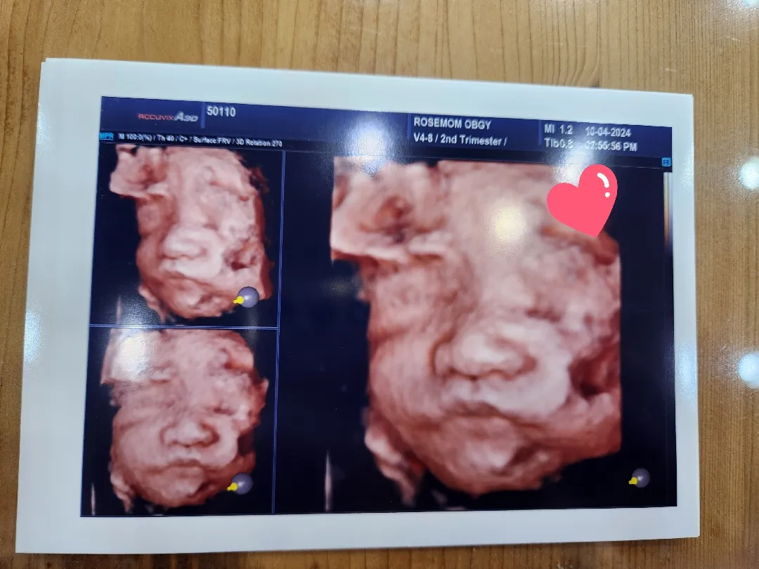 26주 입체초음파+임당검사
