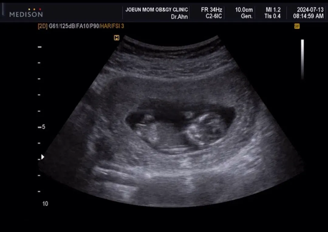 12주 초음파 사진 각도법 봐주세요