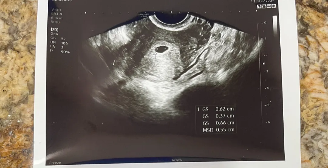 5주 초음파 사진 쌍둥이 가능성?