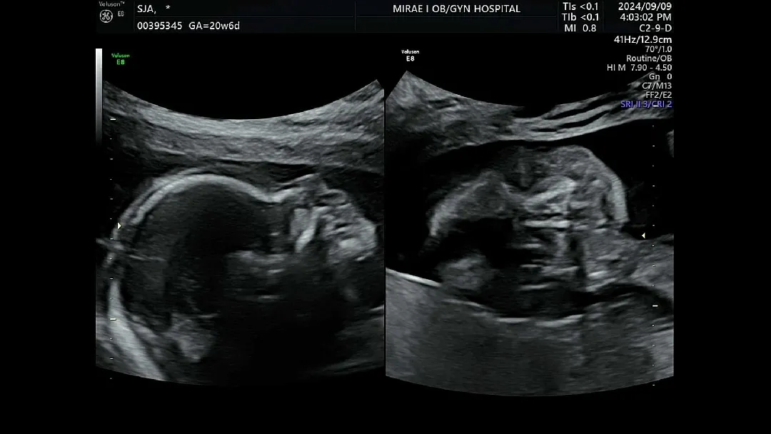 정밀초음파 실패했는데ㅠ새벽마다 활발해요