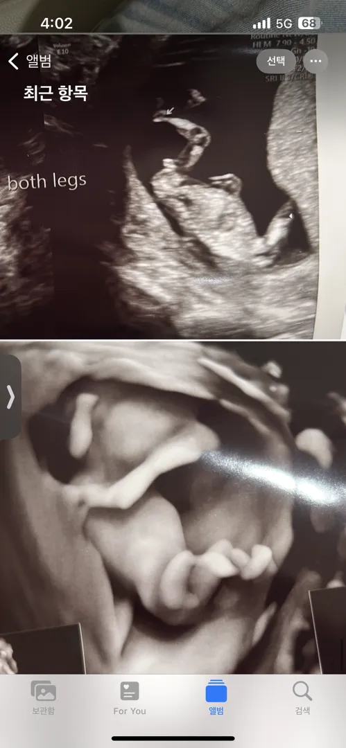 11w6d 초음파.. 성별 컨닝 가능한 때인가요..?