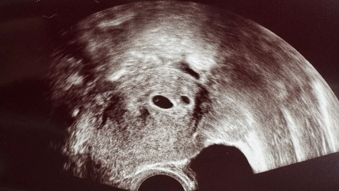 5주1일 둥이 아기집 보고 왔어요