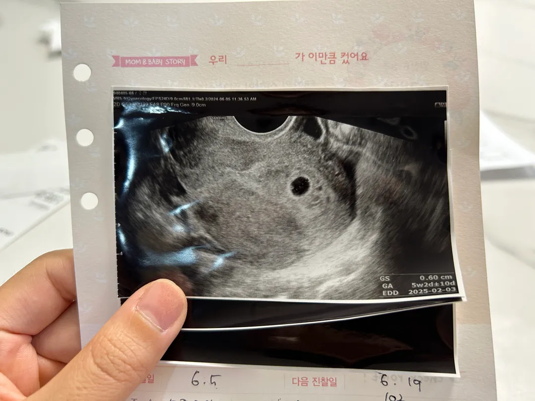 5주 2일차 아기집 보고 왔어요