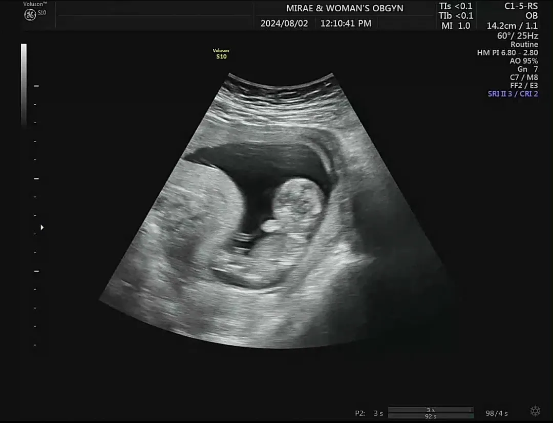 🫶🏻🫶🏻나도 12주5일 각도법/기형아1차 통과🫶🏻🫶🏻