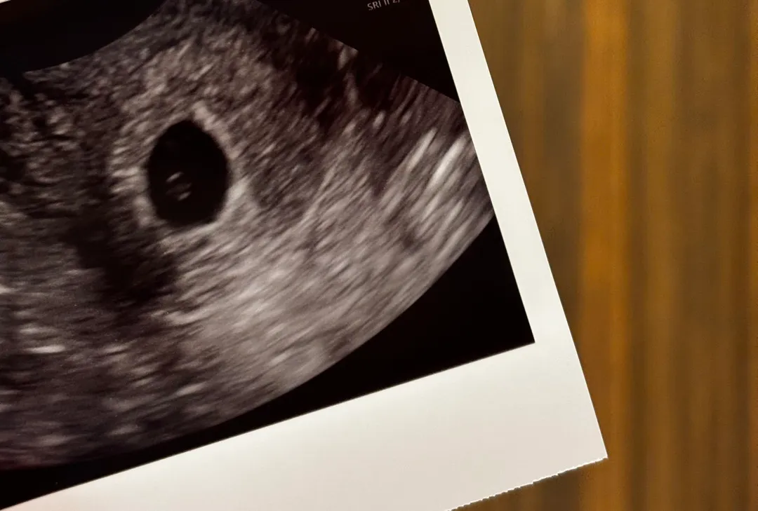 5주차 초음파 보고왔어요(Chorionic bump)