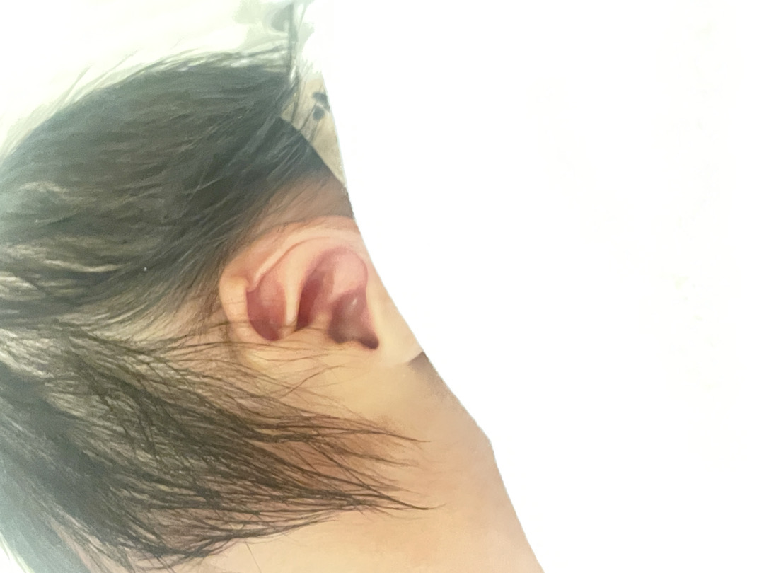 신생아 귀교정