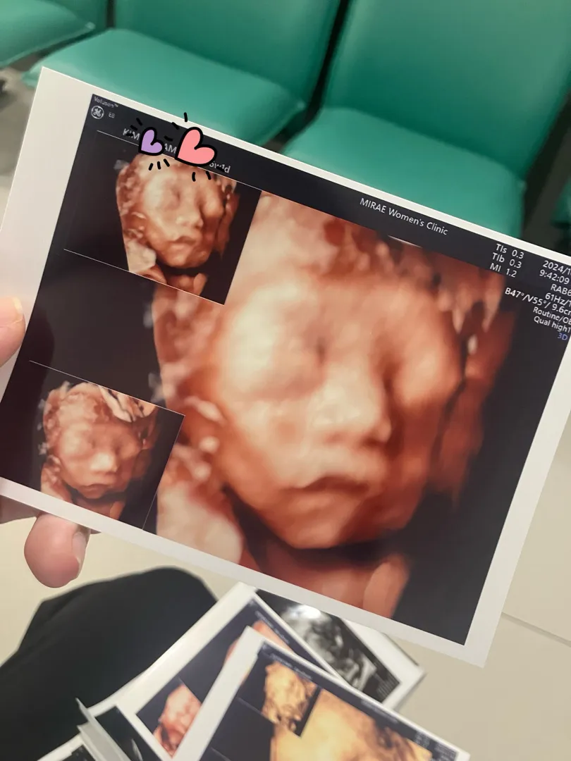 입체초음파 성공했어요