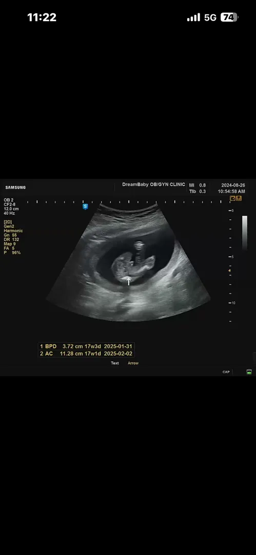 15주 5일 성별 ㅠㅠ 