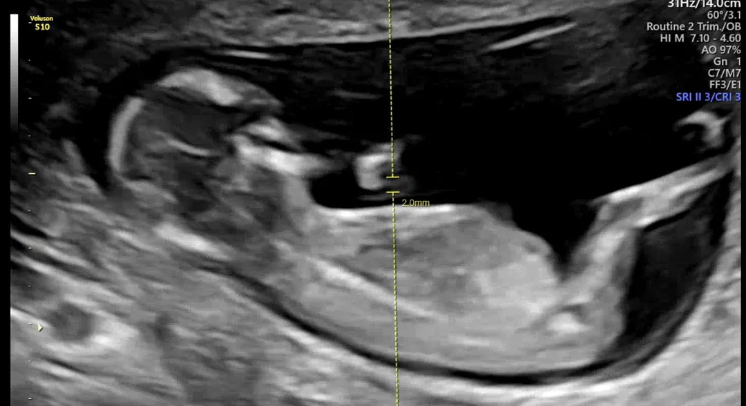 12주3일차 각도법 성별확인 가능한가요…?