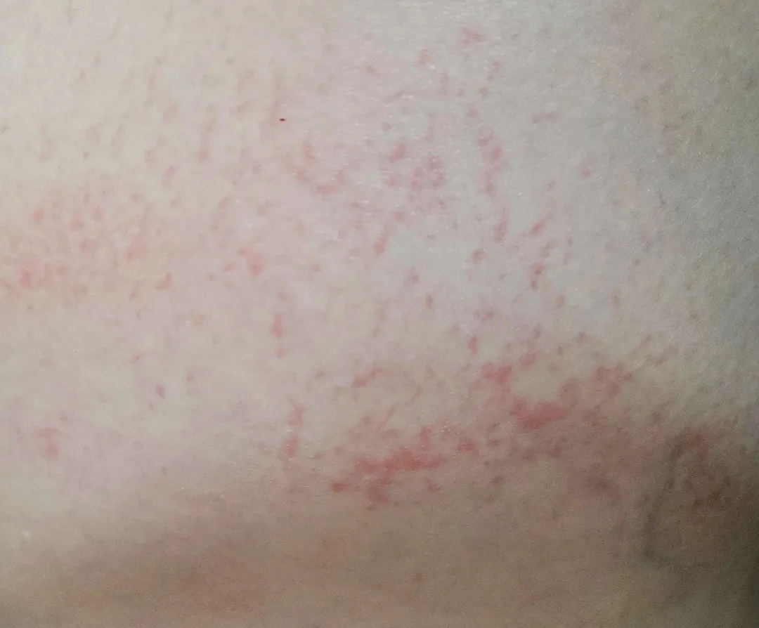 소양증일까요, 튼살일까요?🥲