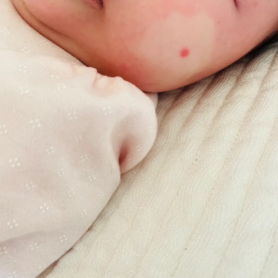 아기 피부 좀 꼭 봐주세요