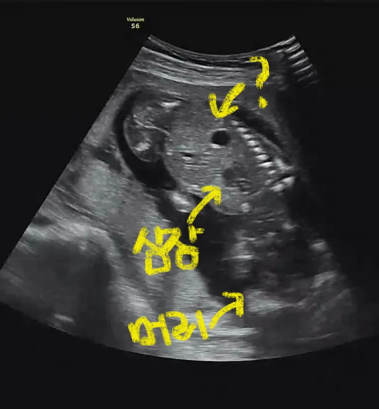 16주 초음파 아기 등에 구멍같은게 뭘까요 ? 
