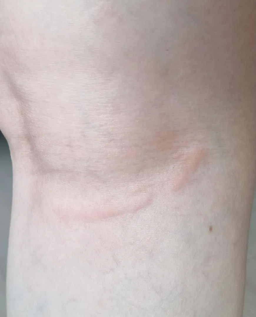 혹시 이게 임신소양증일까요