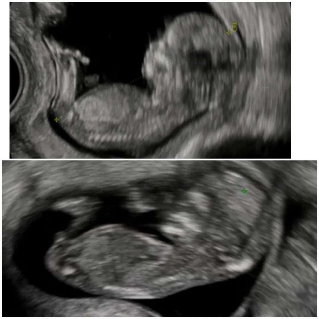12주 쌍둥이 각도법 궁금해요!