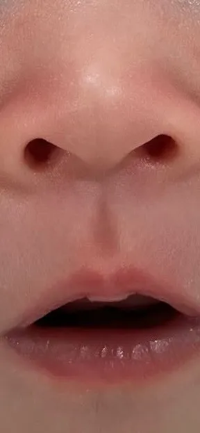 아기 코주름 없어지는 건가요?
