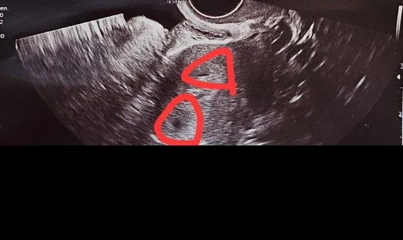 4주2일 초음파사진 쌍둥이 인가요?
