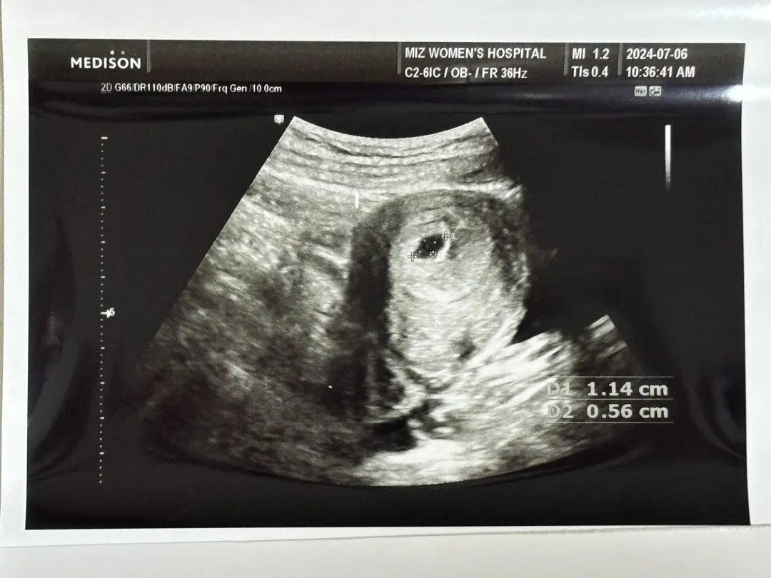 5w6d 초음파 보고 왔어요!