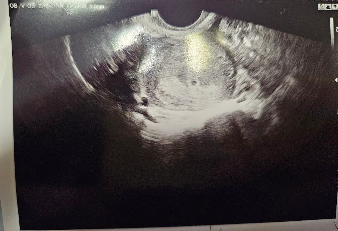 아기집이 너무 작은데 괜찮을까요?
