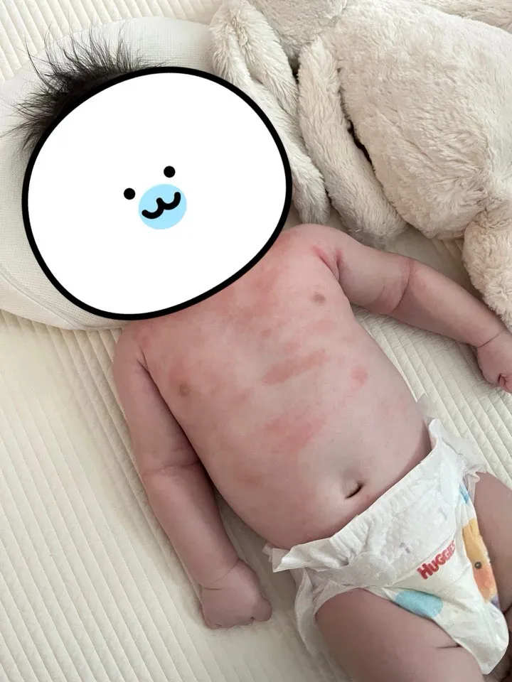 아기 몸에 발진 봐주세요!