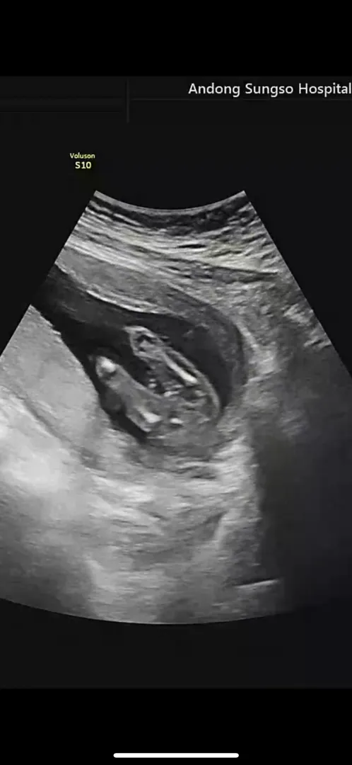 👶🏻성별 봐주세요!!