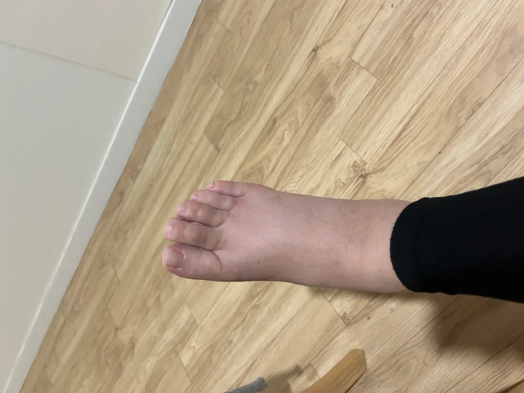 자연분만 후 코끼리발;;