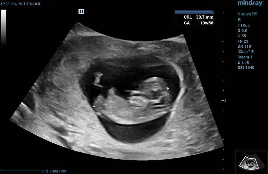 10주5일 초음파 심박수