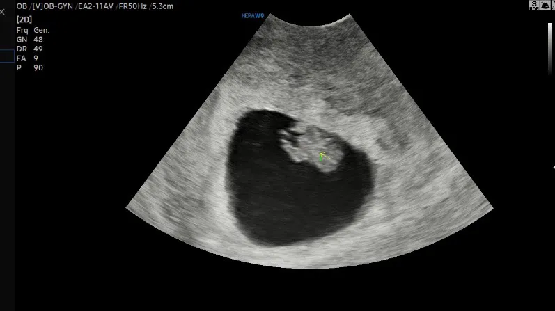 초음파 통닭(8w6d)