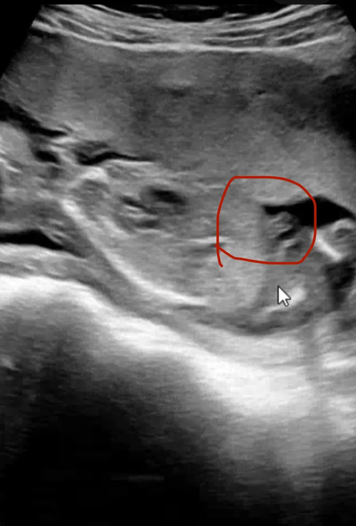 16w6d 성별 확인 좀 부탁듀료요오옹 제발 💙🌶️